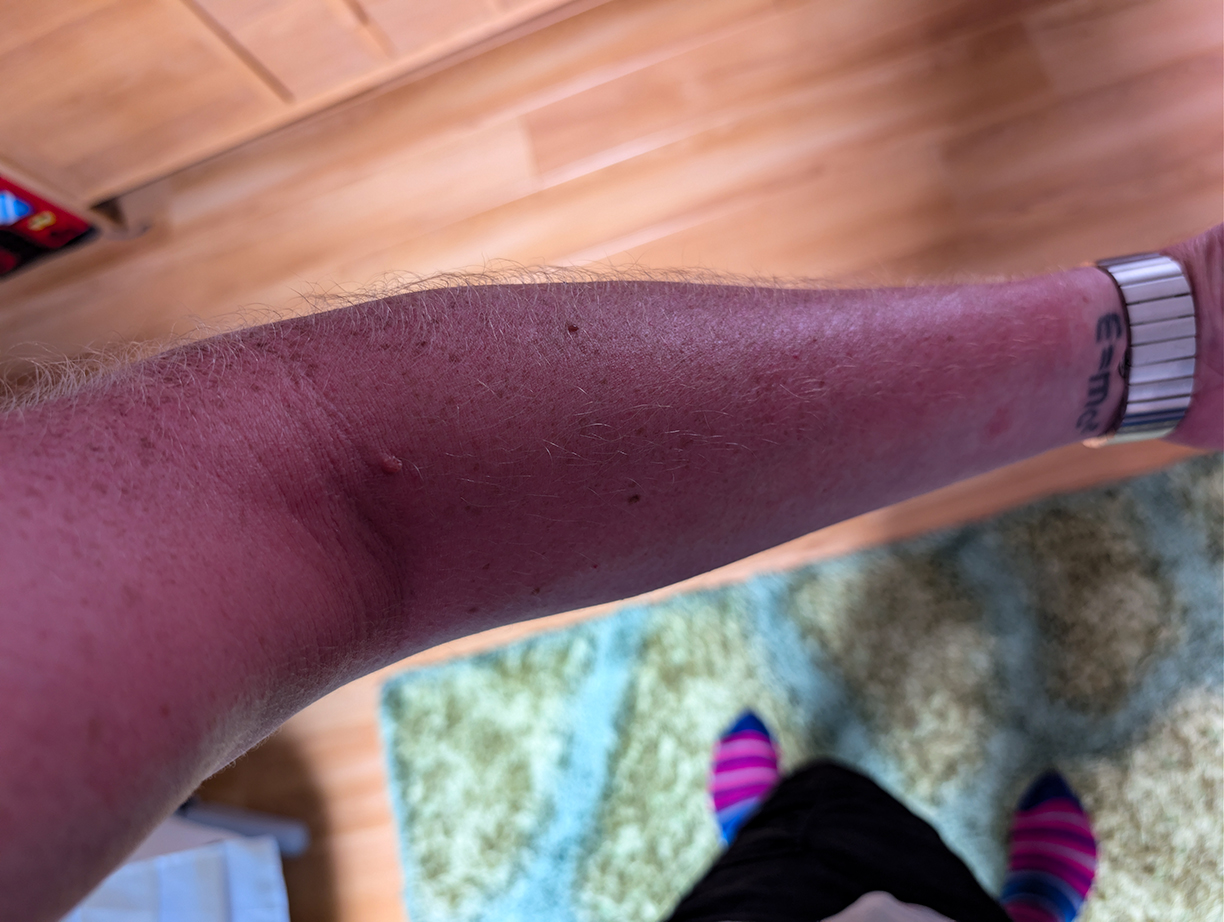 Week 25: Sunburn